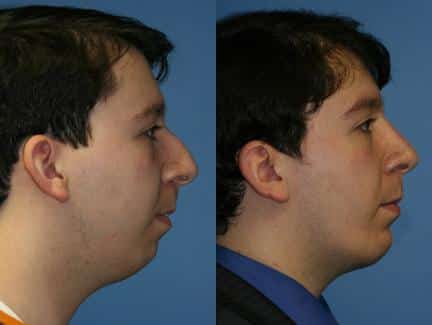 facial asymmetry surgery in new york