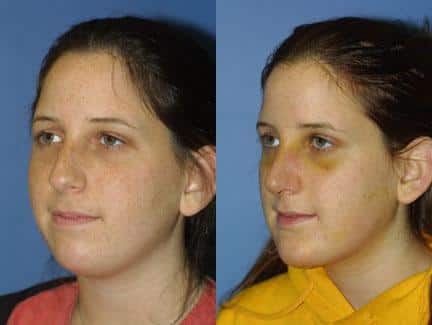 Chin implant to augment the chin and rhinoplasty to straighten the nose of a female patient by Dr. Miller. After surgery, chin has more fullness and definition.