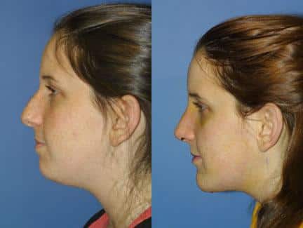 patient-11433-chin-implants-before-after-5