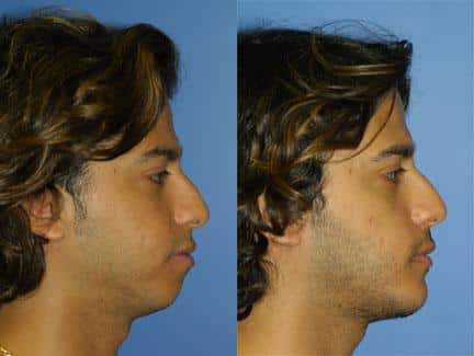 Chin implant to augment the chin and enhance the facial profile of a male patient by Dr. Miller. Surgery creates stronger chin and jawline.