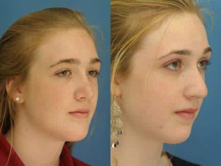 Chin implant to augment the chin and rhinoplasty to straighten the nose of a female patient by Dr. Miller. After surgery, nose and chin have better balance and proportion to enhance the facial profile.