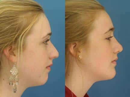 patient-11443-chin-implants-before-after-3