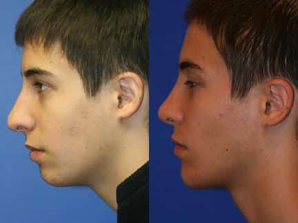 chin implant before and after in new york