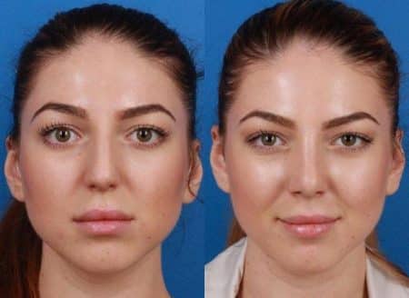 patient-11466-rhinoplasty-nosejob-before-after-3