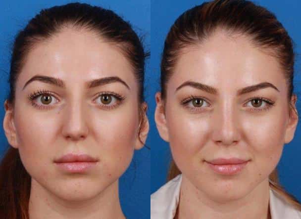 Rhinoplasty to improve the nose shape and refine the tip of a female patient by Dr. Miller. Surgery creates a more balanced, proportionate nose and tip.