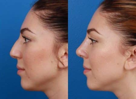 patient-11466-rhinoplasty-nosejob-before-after-5