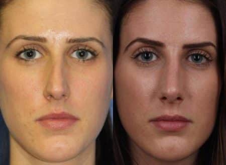 patient-11473-rhinoplasty-nosejob-before-after-6