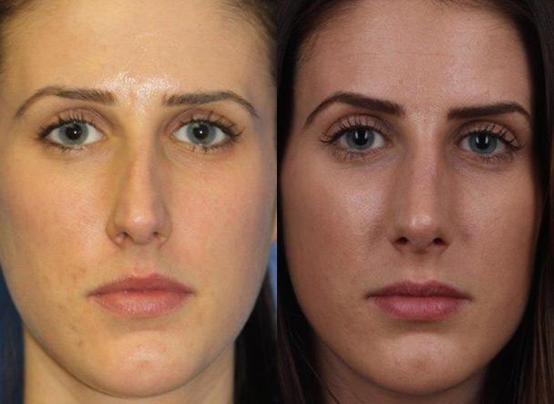 Rhinoplasty to strengthen nasal bridge and refine tip of a female patient by Dr. Miller. Surgery also opens up nasal passages.