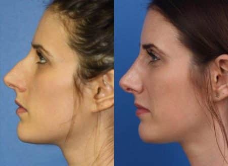 patient-11473-rhinoplasty-nosejob-before-after-7