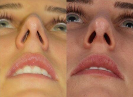 patient-11473-rhinoplasty-nosejob-before-after-8