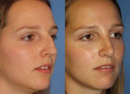 patient-11480-rhinoplasty-nosejob-before-after-6