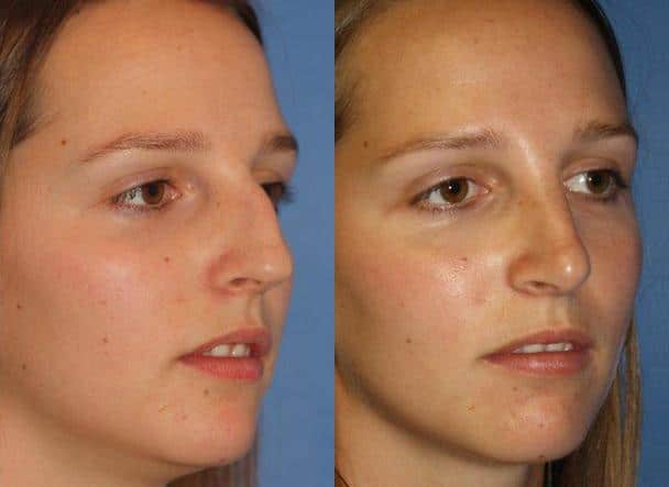 Rhinoplasty to remove dorsal hump and straighten nasal bridge on a female patient by Dr. Miller. Tip is also slightly rotated to eliminate drooping appearance and improve patient's facial profile.