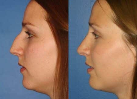 patient-11480-rhinoplasty-nosejob-before-after-9