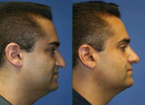 Rhinoplasty to remove a bump from the nasal bridge and refine the tip of a male patient by Dr. Miller. After surgery, bridge is straighter and tip no longer droops downward.