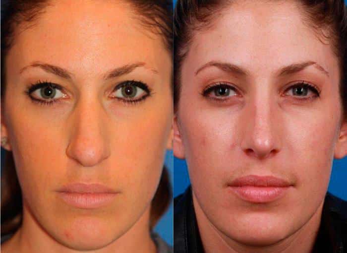 Rhinoplasty to refine nasal bridge and tip of a female patient by Dr. Miller. Surgery creates straighter nose shape with a more aesthetically pleasing tip.