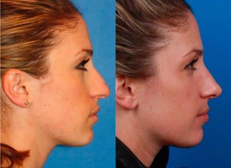 patient-11497-rhinoplasty-nosejob-before-after-4