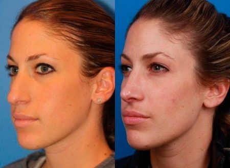 patient-11497-rhinoplasty-nosejob-before-after-5