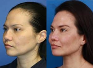 nose job results by dr philip miller