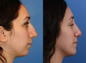 Choosing Right Nose Shape Rhinoplasty New York