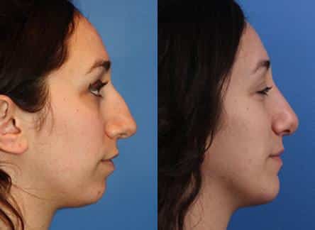 Rhinoplasty to remove dorsal hump and chin implant to strengthen the chin of a female patient by Dr. Miller. After surgery, hump is gone and patient's facial profile is improved.