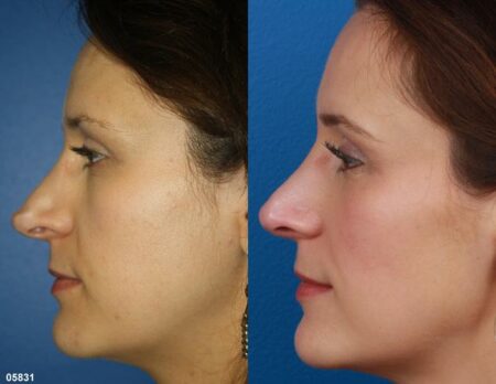 patient-11519-rhinoplasty-nosejob-before-after-10