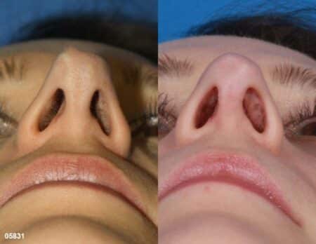 patient-11519-rhinoplasty-nosejob-before-after-11