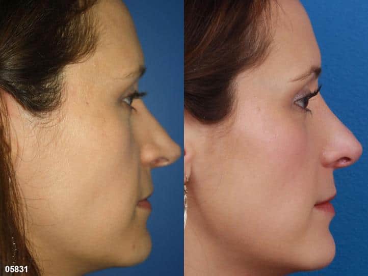 Rhinoplasty to correct nasal bridge and tip of a female patient by Dr. Miller. Surgery creates straighter bridge and more rounded, refined nasal tip to improve the patient's facial profile.