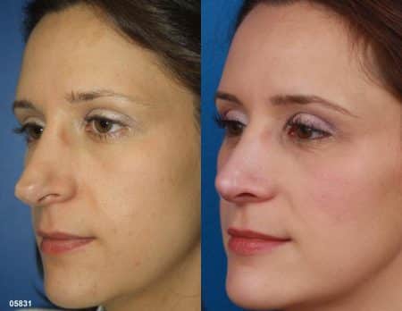 patient-11519-rhinoplasty-nosejob-before-after-9