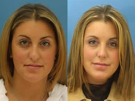 Rhinoplasty to improve the nose shape and refine the tip of a female patient by Dr. Miller. Surgery creates a more proportionate feature while improving the shape of the nasal tip.