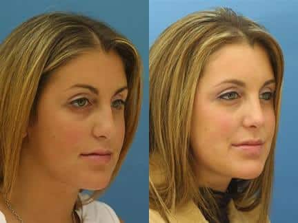 patient-11539-rhinoplasty-nosejob-before-after-6