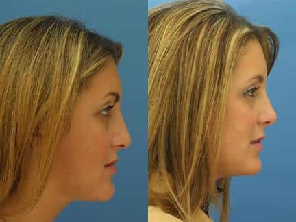patient-11539-rhinoplasty-nosejob-before-after-7