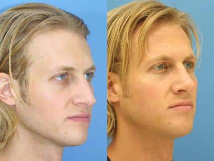 Rhinoplasty to straighten nasal bridge and correct tip of a male patient by Dr. Miller. Surgery creates stronger profile with a straight bridge and slightly rotated nasal tip.