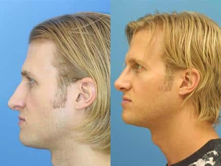 patient-11550-rhinoplasty-nosejob-before-after-3
