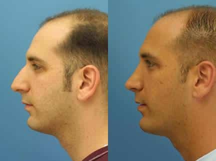 Rhinoplasty to remove dorsal hump and straighten nasal bridge on a male patient by Dr. Miller. Surgery refines nasal bridge and tip to improve the facial profile.