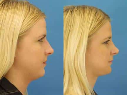 Rhinoplasty to straighten nasal bridge of a female patient by Dr. Miller. Surgery removes small dorsal hump to improve patient's facial profile.