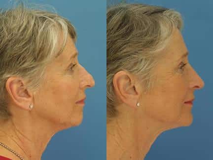 nose job for patients over 50