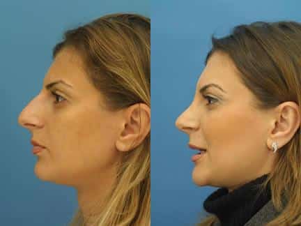 Rhinoplasty to straighten nasal bridge of a female patient by Dr. Miller. Surgery creates more feminine slope to the nose to improve the patient's facial profile.