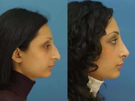 Rhinoplasty to straighten nasal bridge of a female patient by Dr. Miller. Nasal bridge has more aesthetically pleasing slope and nasal tip is refined to create an improved facial profile.
