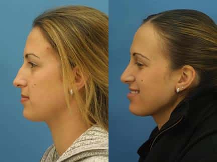 Rhinoplasty to remove dorsal hump and straighten nasal bridge on a female patient by Dr. Miller. Surgery creates a more feminine slope to the nose and improves the patient's facial profile.