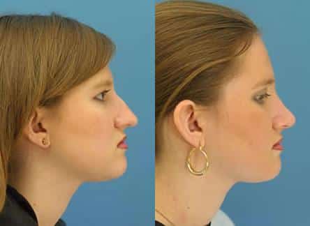 Rhinoplasty to remove dorsal hump and straighten nasal bridge on a female patient by Dr. Miller. Surgery enhances slope of the nose and refines the tip to create a more aesthetically pleasing facial profile.