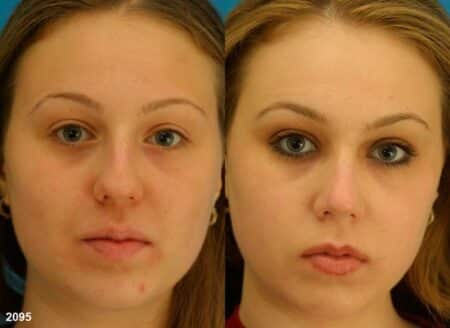 patient-11617-rhinoplasty-nosejob-before-after-3