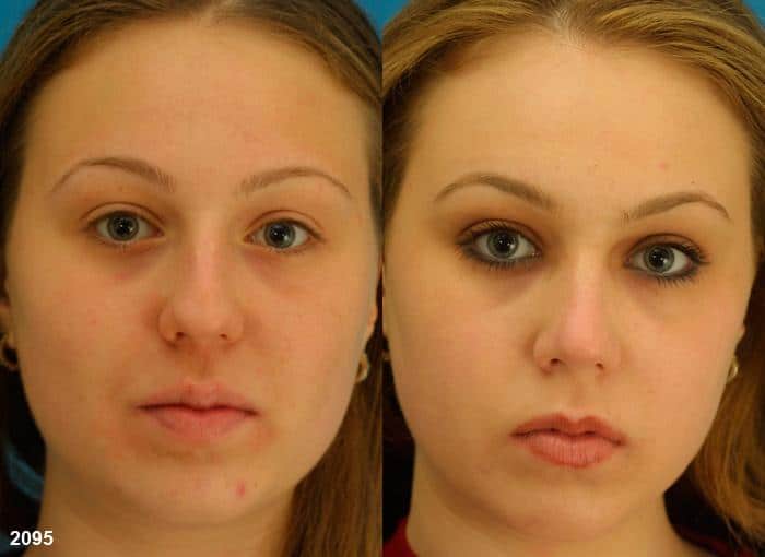 Rhinoplasty to straighten nasal bridge of a female patient by Dr. Miller. As surgery improves the nasal bridge, the overall shape and contour of the nose is also improved.