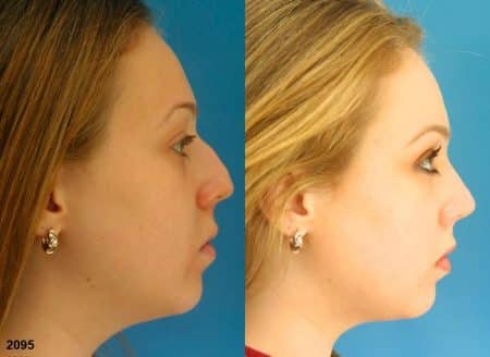 patient-11617-rhinoplasty-nosejob-before-after-5