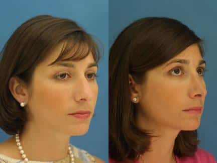 Rhinoplasty to straighten nasal bridge of a female patient by Dr. Miller. Surgery creates a more aesthetically pleasing slope to the nose and gently refines the tip to enhance the facial profile.