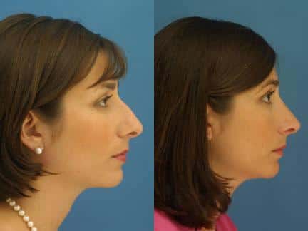 patient-11629-rhinoplasty-nosejob-before-after-3
