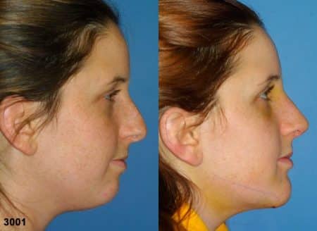 patient-11649-rhinoplasty-nosejob-before-after-1