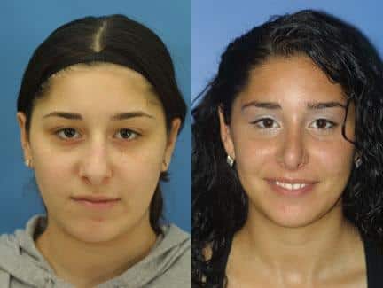 Rhinoplasty to correct nose shape of a female patient by Dr. Miller. Surgery creates nose that is more proportionate and balanced with the other facial features.