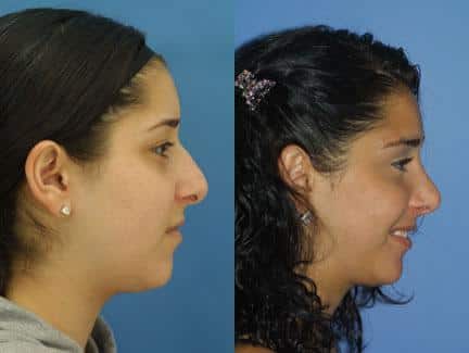 patient-11652-rhinoplasty-nosejob-before-after-5