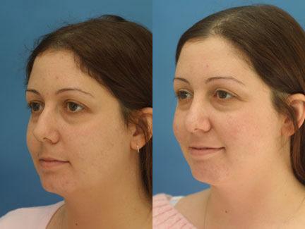 Rhinoplasty to remove dorsal hump and straighten nasal bridge on a female patient by Dr. Miller. Surgery enhances both nasal bridge and tip to improve the facial profile overall,