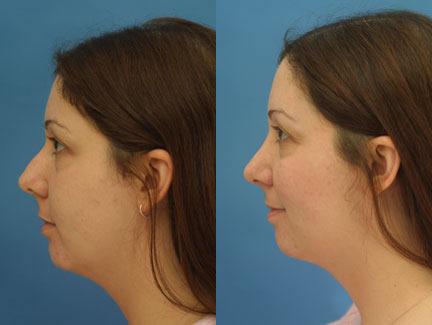 patient-11659-rhinoplasty-nosejob-before-after-3